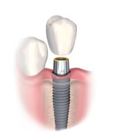 20150920-implant_img2_1_.jpg 20150920-implant_img2_1_.jpg